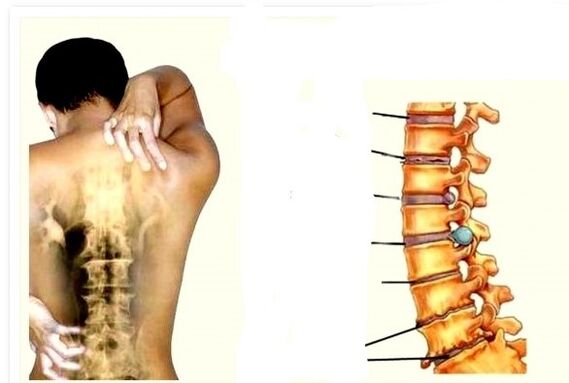 Osteokondroz sırt ağrısının nedenidir