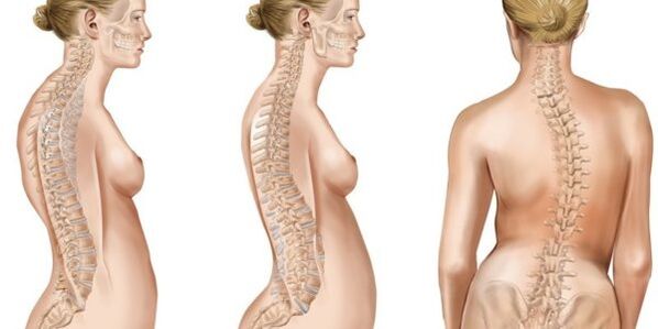 İntervertebral disklerin skolyoz karışımı