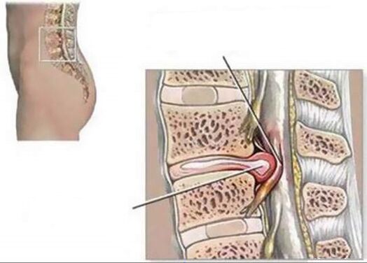 İntervertebral fıtık sırt ağrısına neden olur